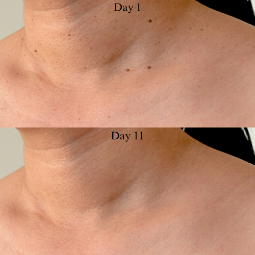 TagBuddy Kit™ – No More Skin Tags