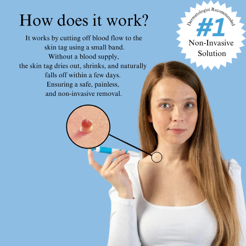 TagBuddy Kit™ – No More Skin Tags