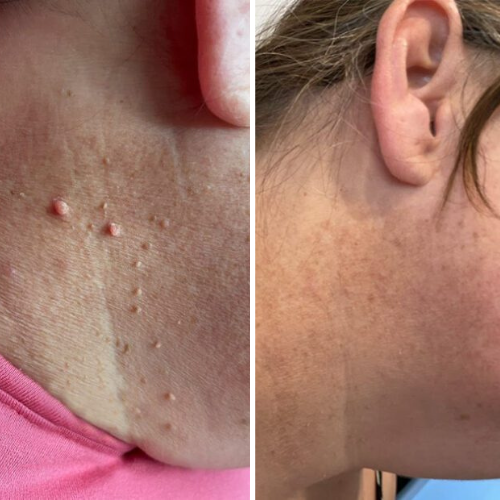 TagBuddy Kit™ – No More Skin Tags