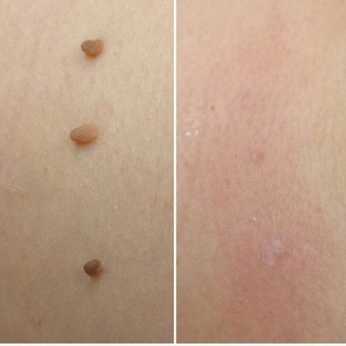 TagBuddy Kit™ – No More Skin Tags