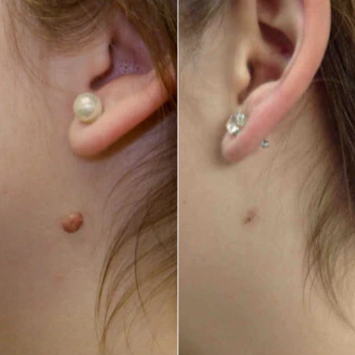 TagBuddy Kit™ – No More Skin Tags